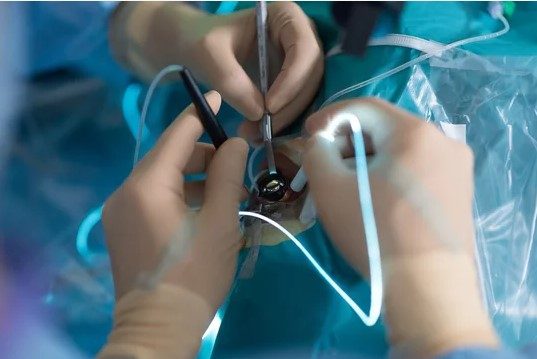 Flushing tubes, pump tubes, suction tubes. Eye surgery in the operating theater. Many tubes and handpieces as instruments